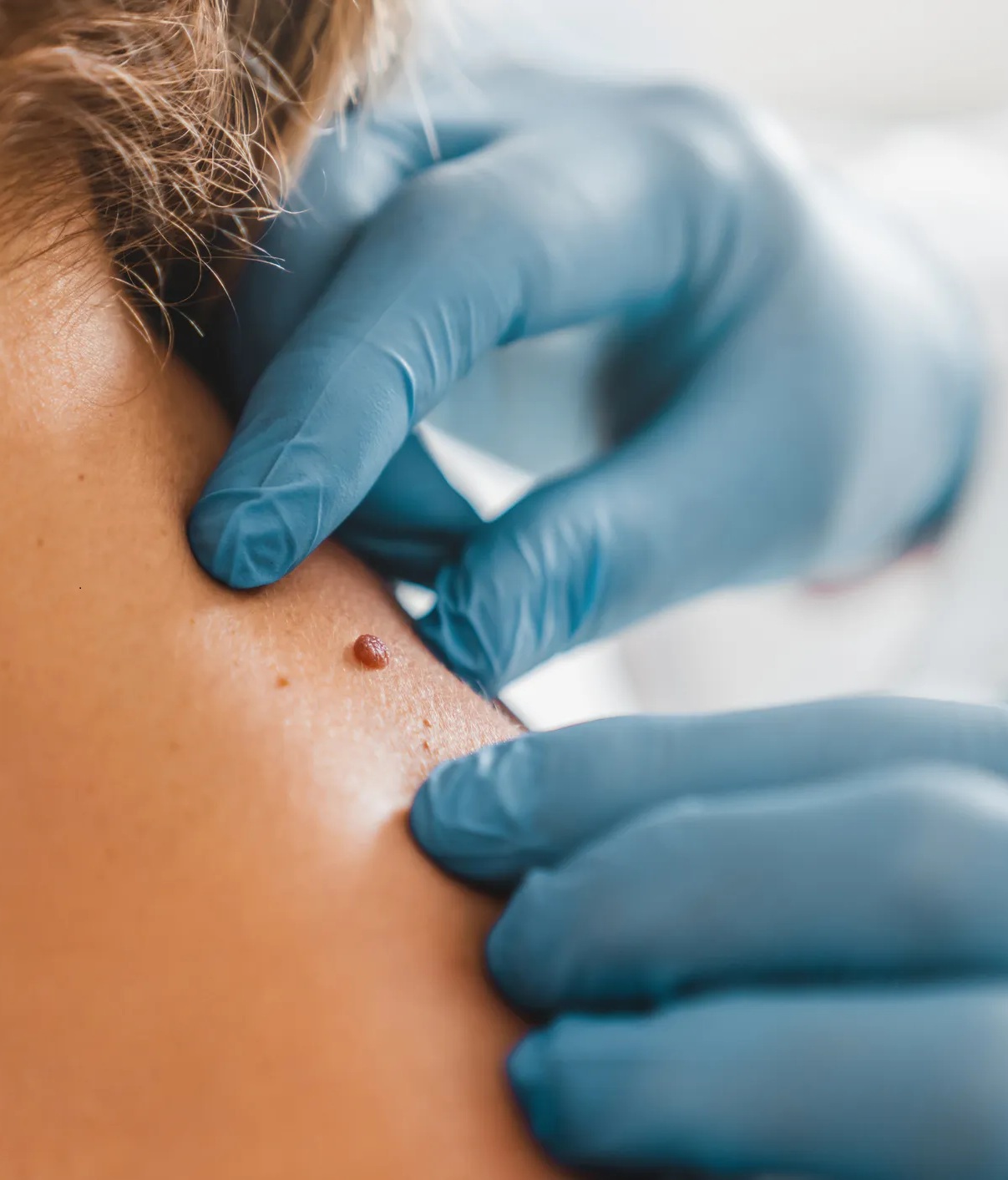 ازالة الزوائد الجلدية طبيًا: الليزر، الجراحة، والتجميد!