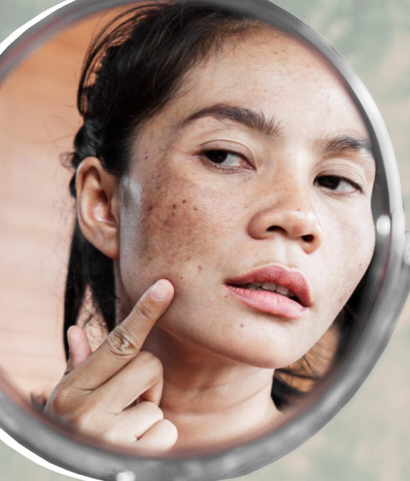 بقع بنية على الجلد بدون حكة... اليك الاسباب والحلول!