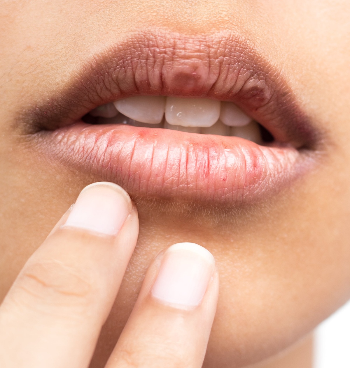 جفاف الشفاه