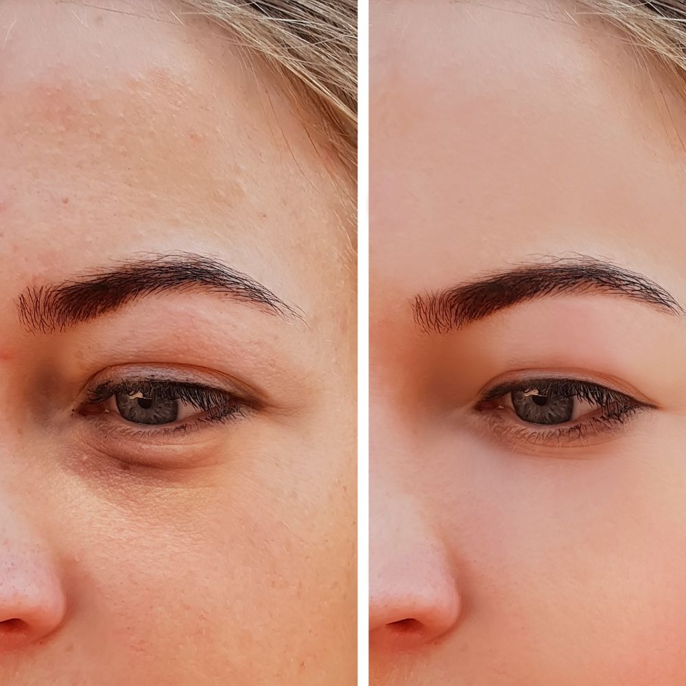 فيلر تحت العين قبل وبعد