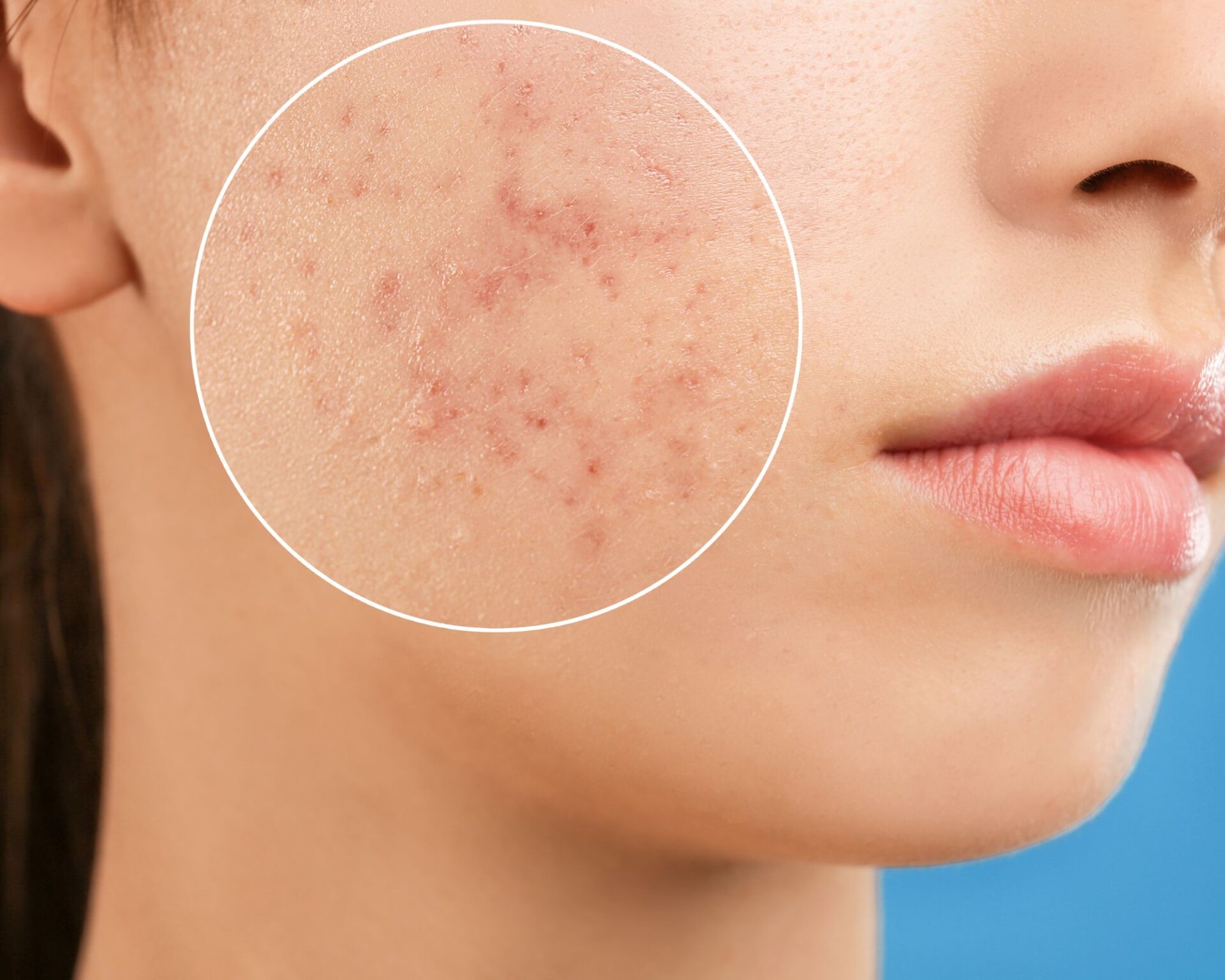 شكل الوجه قبل ليزر فراكشنال للندبات
