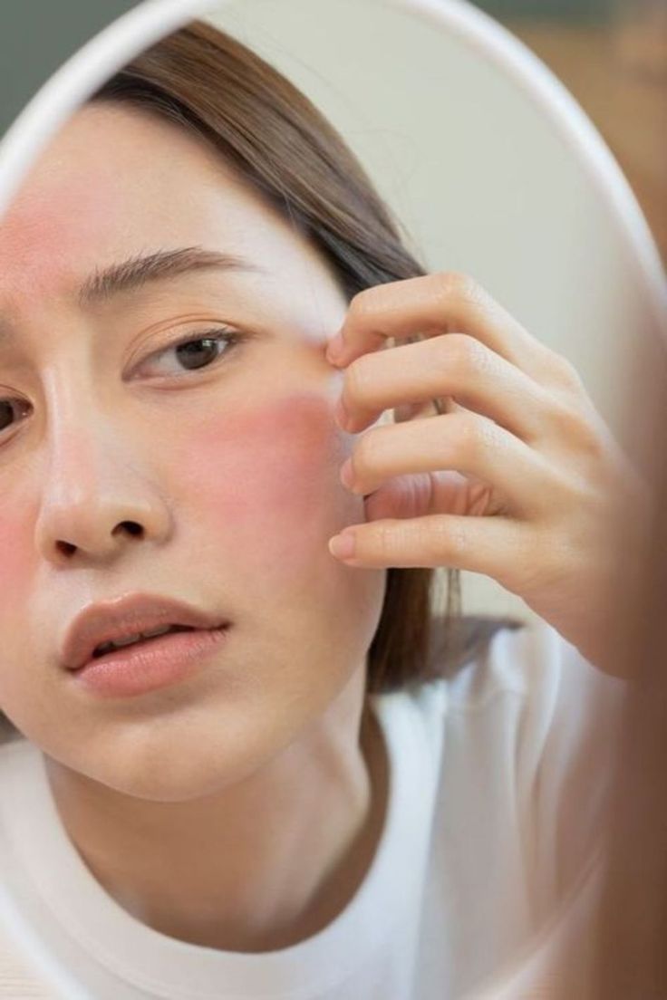 الحكة نتيجة صدفية الوجه