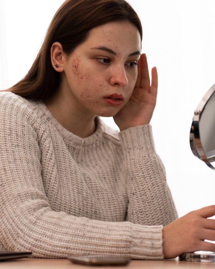 صدفية الوجه