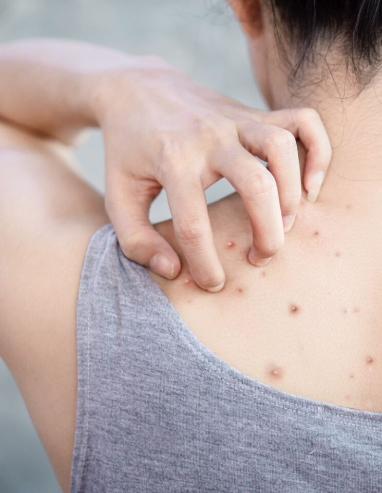 حب الشباب في الظهر مشكلة جلدية شائعة: أسبابها وطرق التعامل معها!