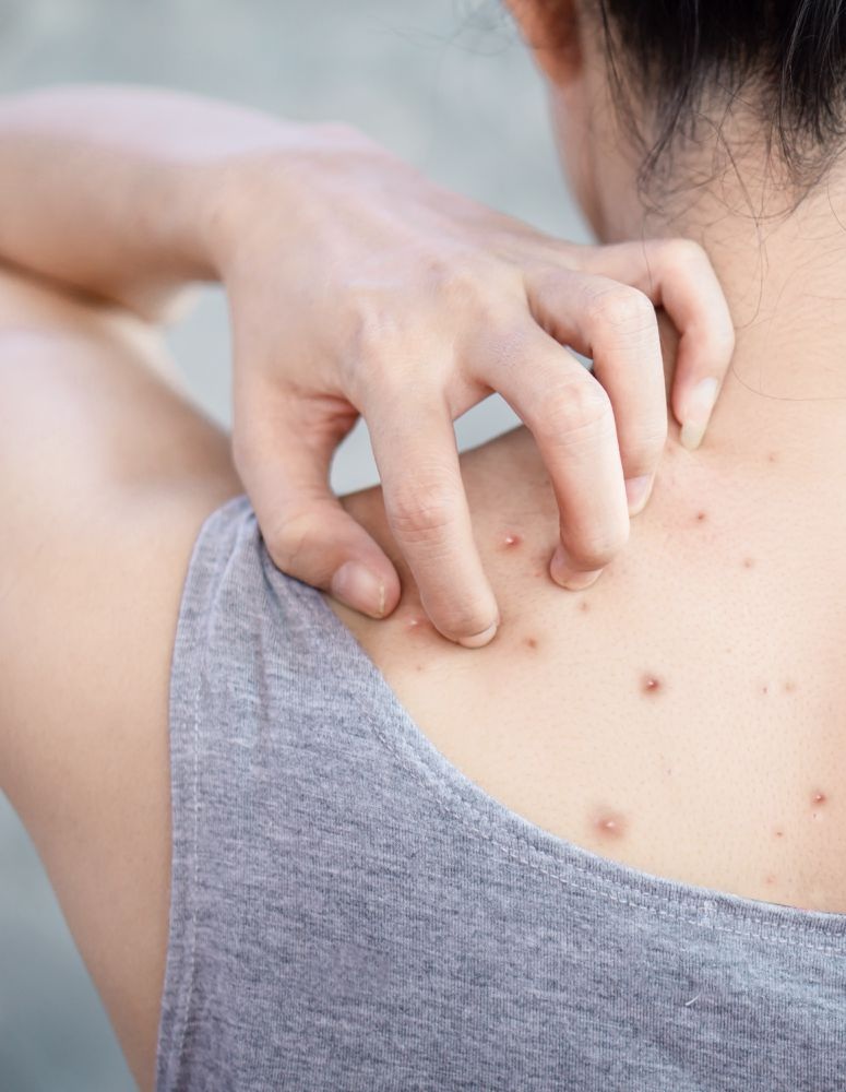 حب الشباب في الظهر مشكلة جلدية شائعة: أسبابها وطرق التعامل معها!