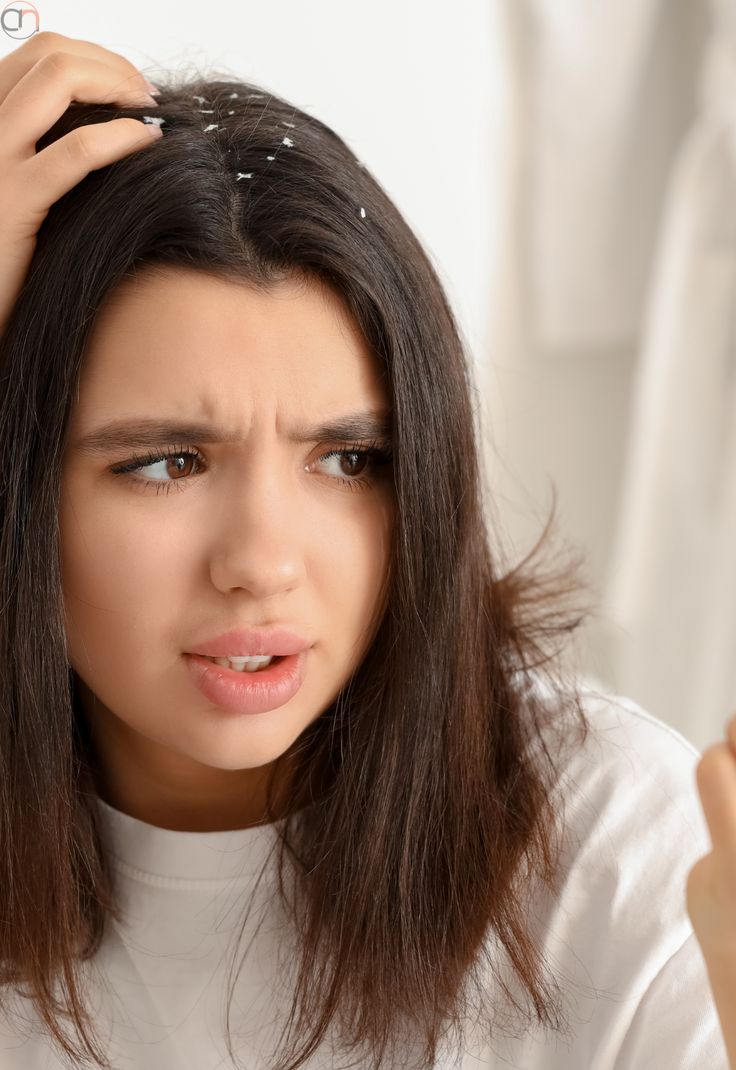 علاج القشرة في البيت باستخدام مكونات طبيعية متوفرة وآمنة!