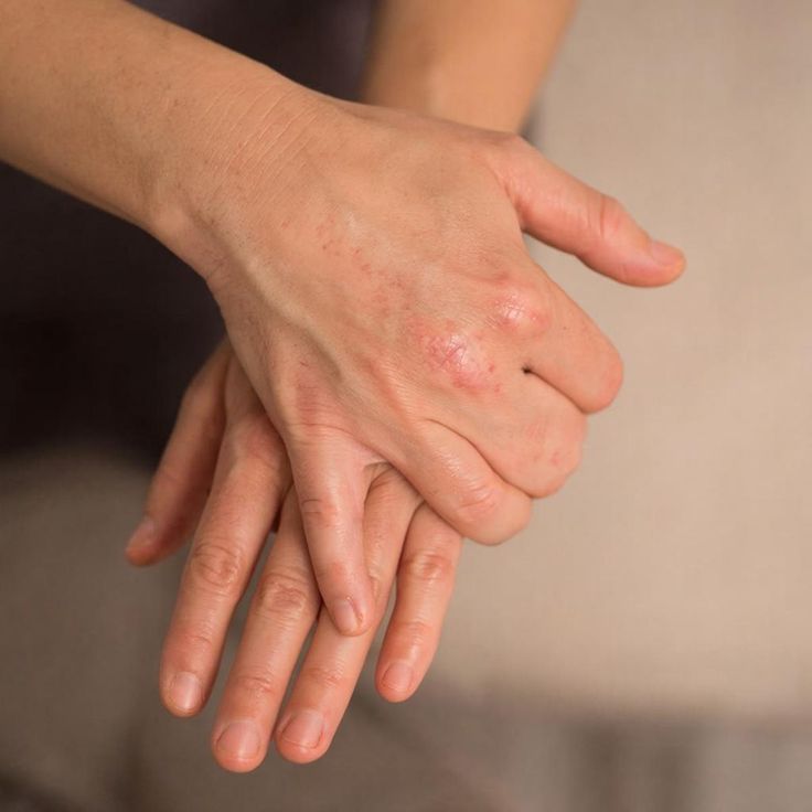 حبوب صغيرة في اليد بدون حكة… كل ما عليك معرفته!